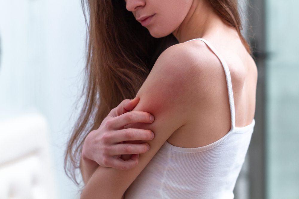 الجفاف المزمن بسبب الحكة والتقشير - Shutterstock