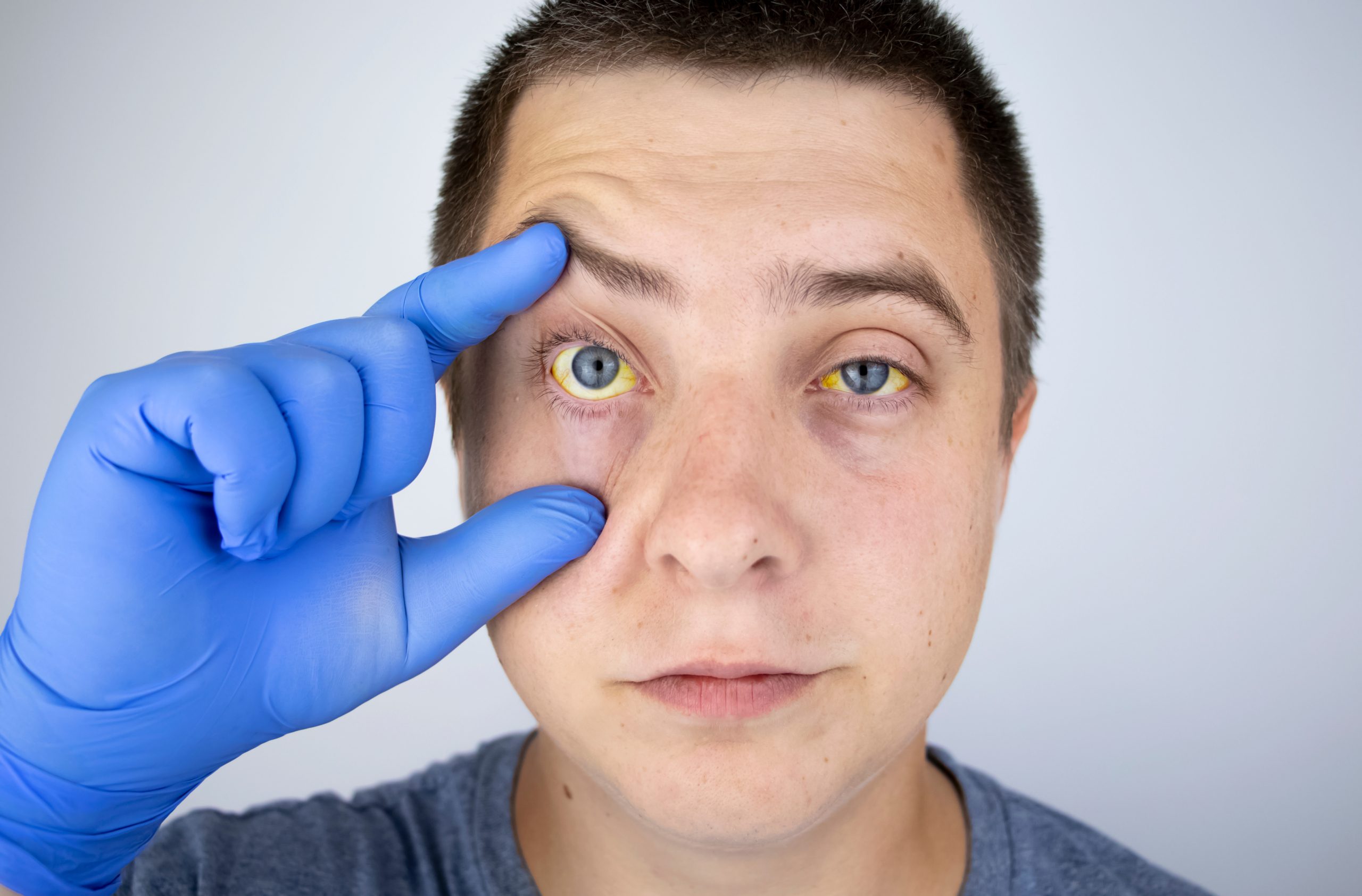 متلازمة جيلبرت