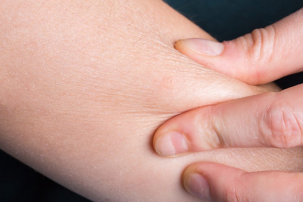 جفاف الجلد أثناء الحمل يحدث بسبب الهرمونات وتغيرات الجسم - ShutterStock