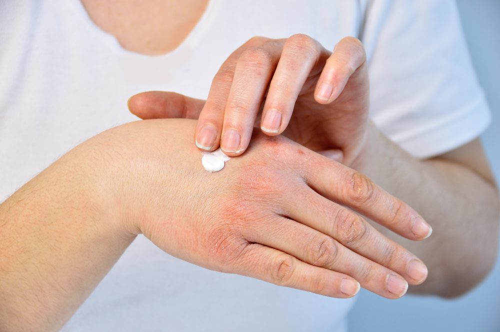 من الضروري الترطيب العميق للبشرة خلال اليوم - Shutterstock