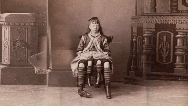 عاشت حياتها برحمين و4 أرجل! قصة حياة الأمريكية “جوزفين ميرتل كوربين” المذهلة