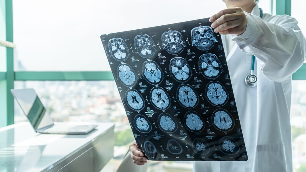 تشخيص مرض المويامويا| shutterstock