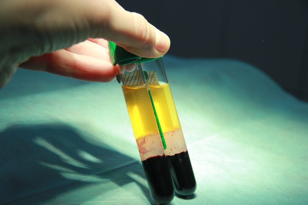 الإجراء التجميلي يتضمن سحب الدم من ذراع الشخص المعني واستخدامه - Shutterstock
