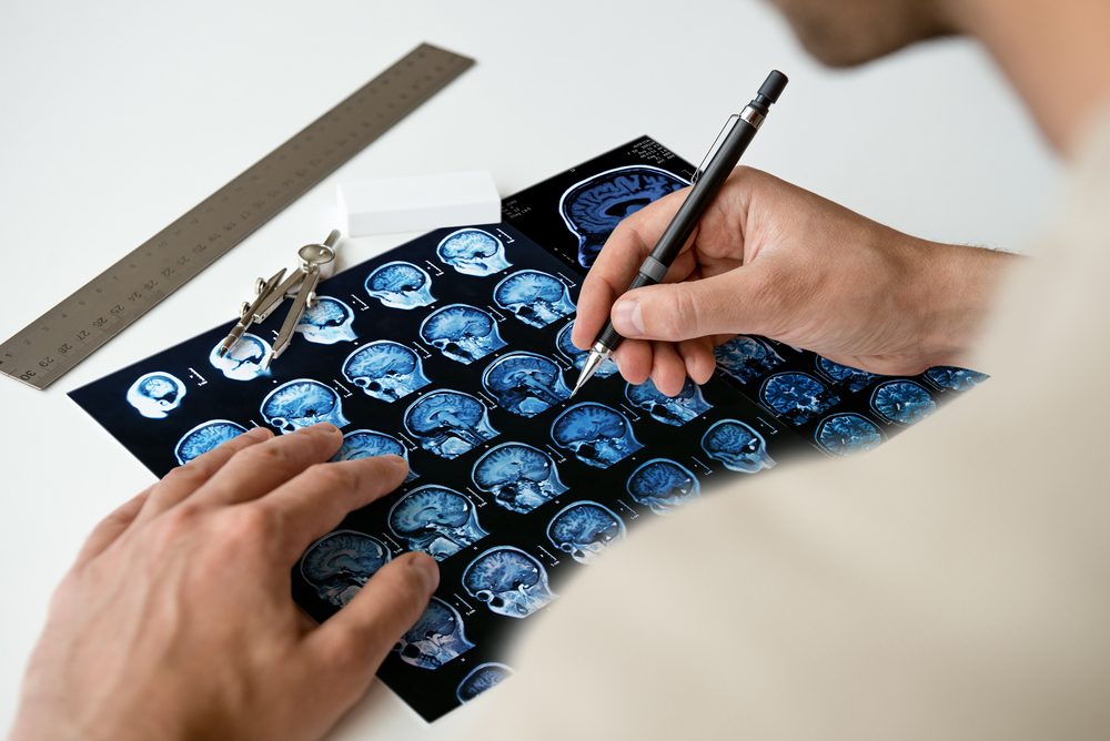 التصلب اللويحي