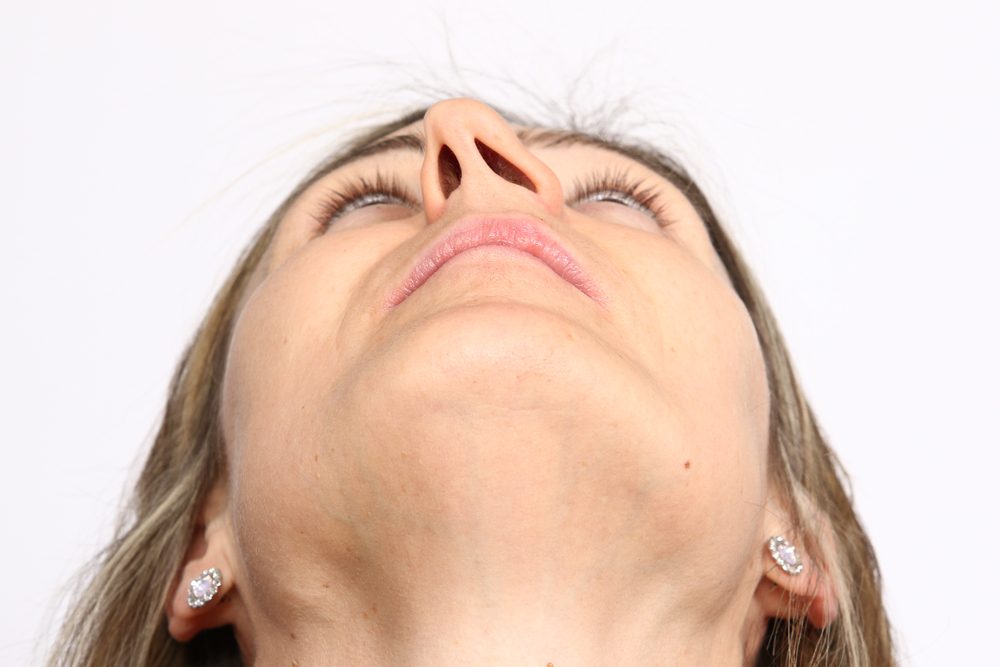 إنحراف الحاجز الأنفي | shutterstock