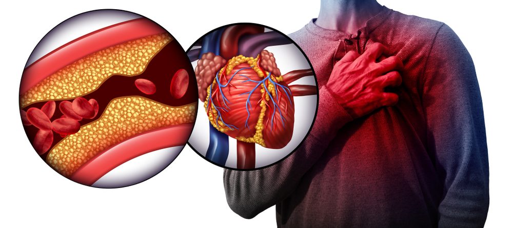 ماذا يحدث أثناء النوبة القلبية| shutterstock