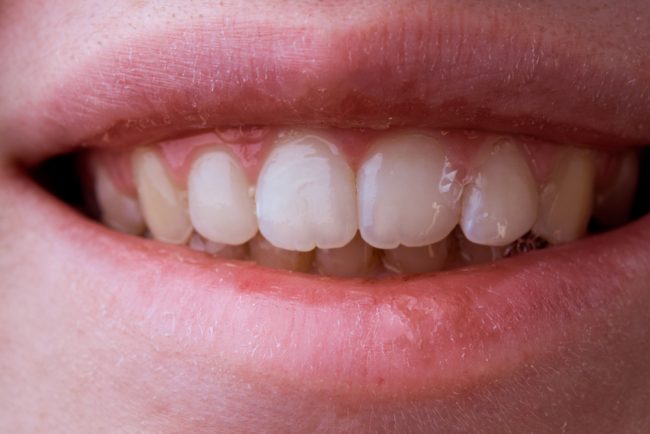 مشكلة تهدد الثقة بالنفس وتستمر مدى الحياة.. أسباب “الأسنان المشرشرة” لدى البالغين و4 خيارات للعلاج