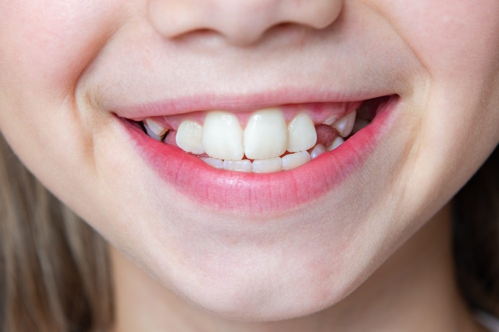 من الطبيعي رؤية الأسنان المموجة لدى الأطفال الصغار - ShutterStock