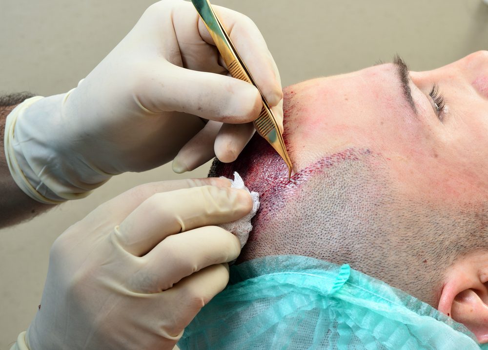 التعامل اللطيف مع فروة الرأس بعد الزراعة يضمن التعافي ونمو الشعر القوي - ShutterStock