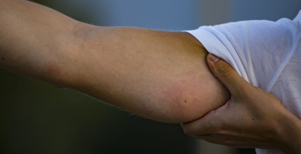 لدغة البعوض