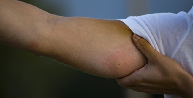 لدغة البعوض