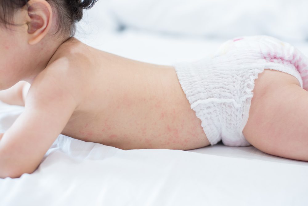 علاج حساسية الجلد عند الأطفال في المنزل