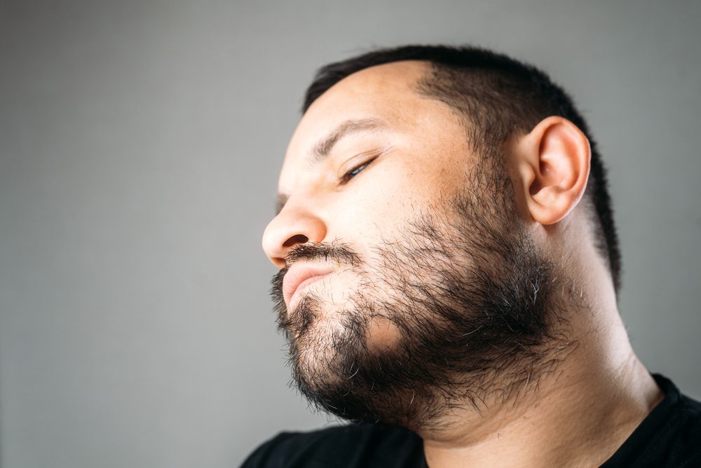 فراغات اللحية بسبب الثعلبة| shutterstock