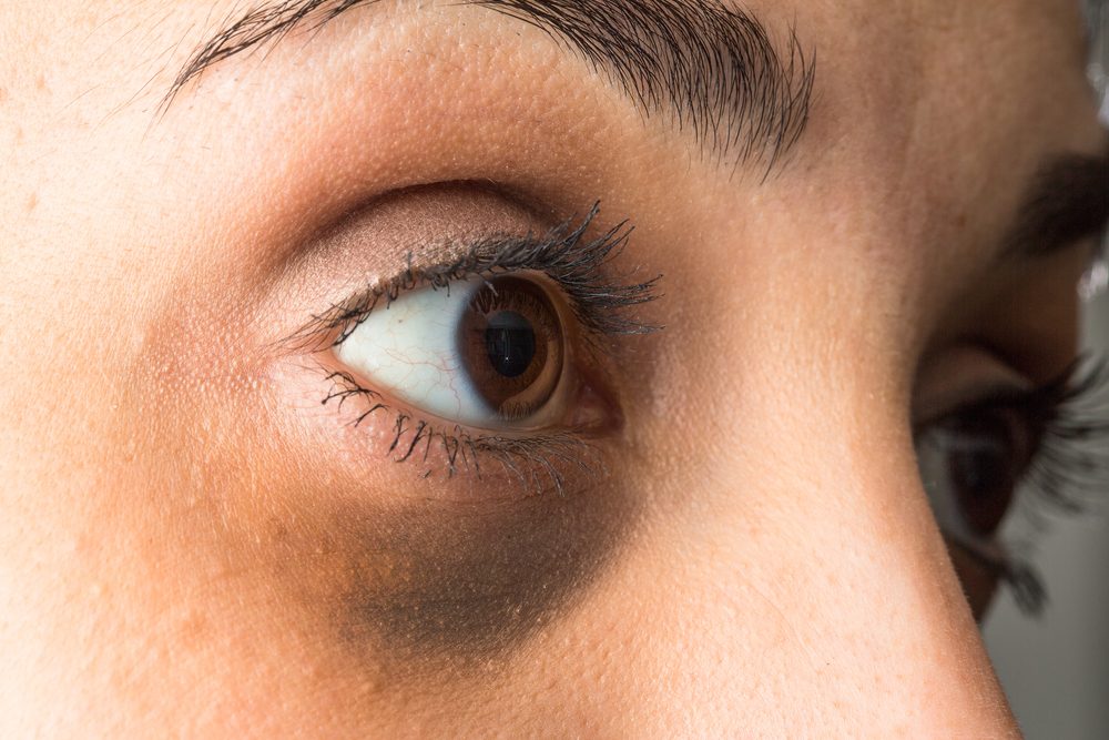 الهالات السوداء| shutterstock