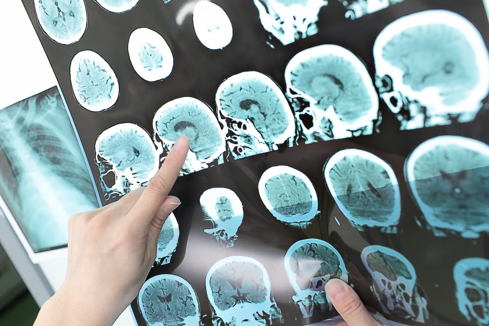 تأثير الصدمات النفسية على الدماغ| shutterstock