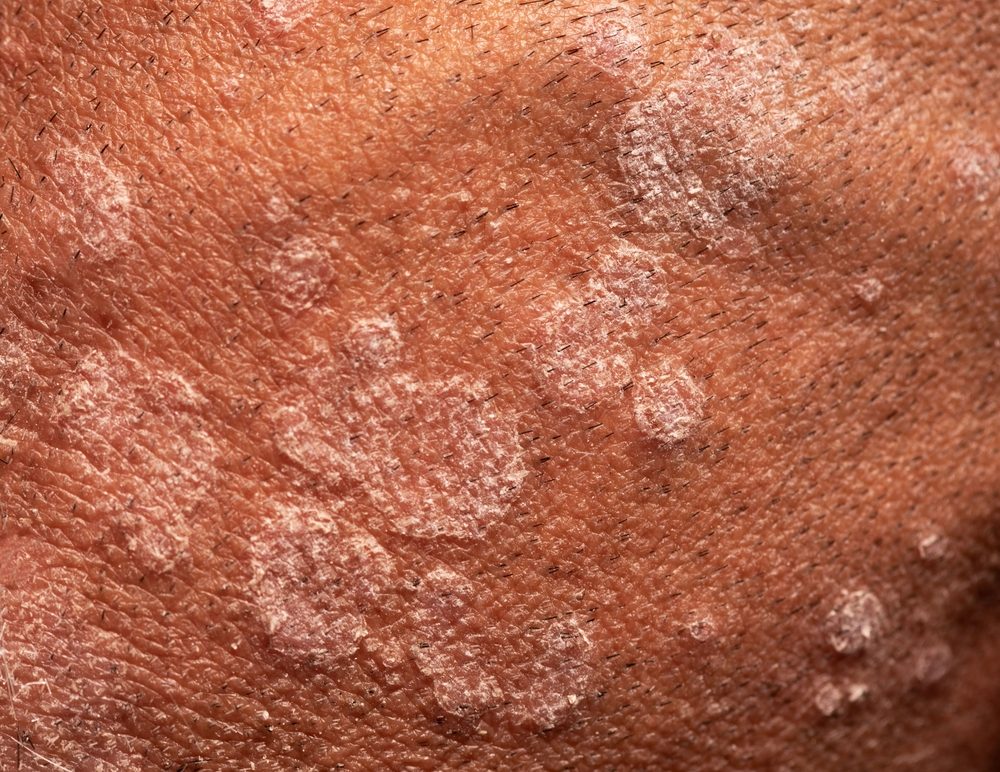 بعد وفاة جندي إسرائيلي بنوع مجهول منها التقطه في قطاع غزة.. أخطر 10 فطريات فتاكة مسببة للعدوى والموت