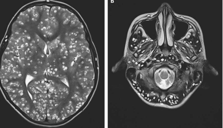 بيض ديدان شريطية
