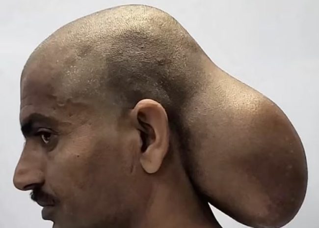 بدا كما لو أنه برأسين.. قصة هندي عانى من ورم في جمجمته لمدة 15 عاماً، هكذا تخلص منه