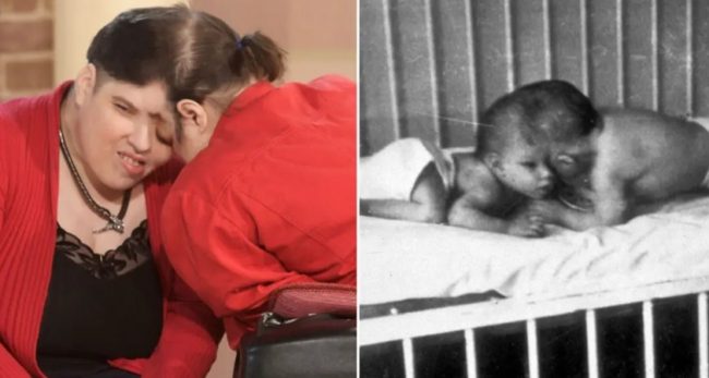 وفاة أكبر توأمين ملتصقين في العالم.. عاشا معاً 62 عاماً وتحديا كل التوقعات الطبية