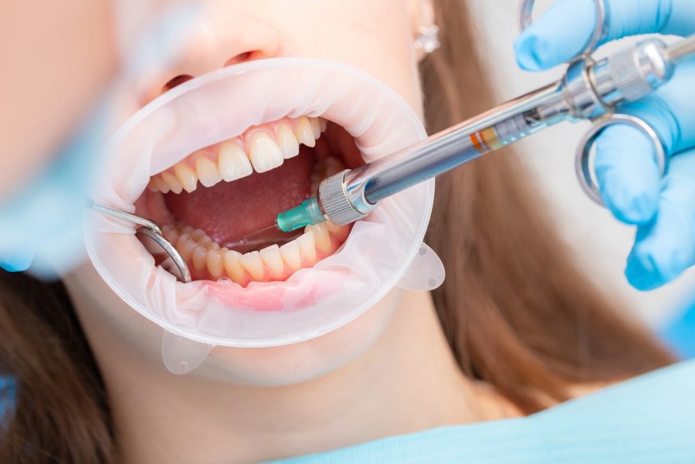عملية تخدير الشفاه| shutterstock