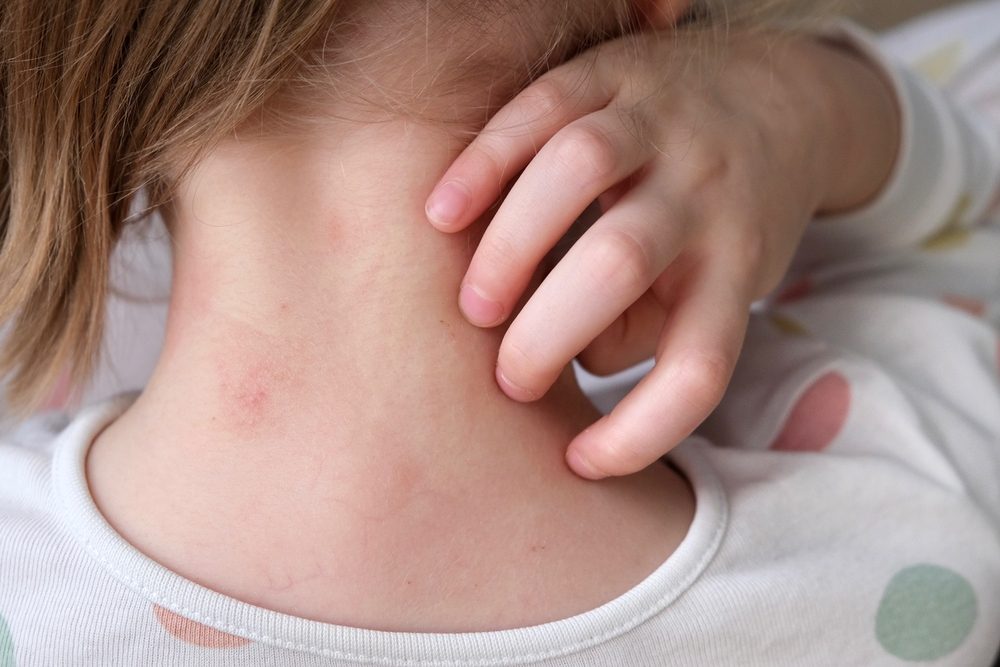 تختلف اعراض البالغين عن التي تصيب الأطفال الصغار - shutterstock