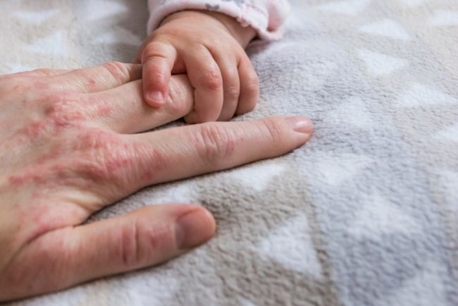 تغيّر الهرمونات يلعب دوراً كبيراً.. أسباب الأكزيما بعد الحمل وطرق علاجها والوقاية منها