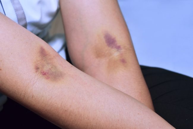 قد ينتج عن تناول بعض المنشطات والأدوية.. ما هو مرض فرفرية “purpura” وكيف يمكن علاجه؟