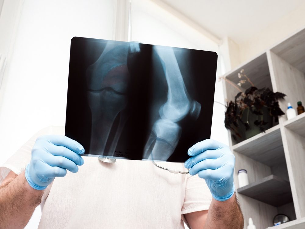 تشخيص تجمع السوائل في الركبة| shutterstock