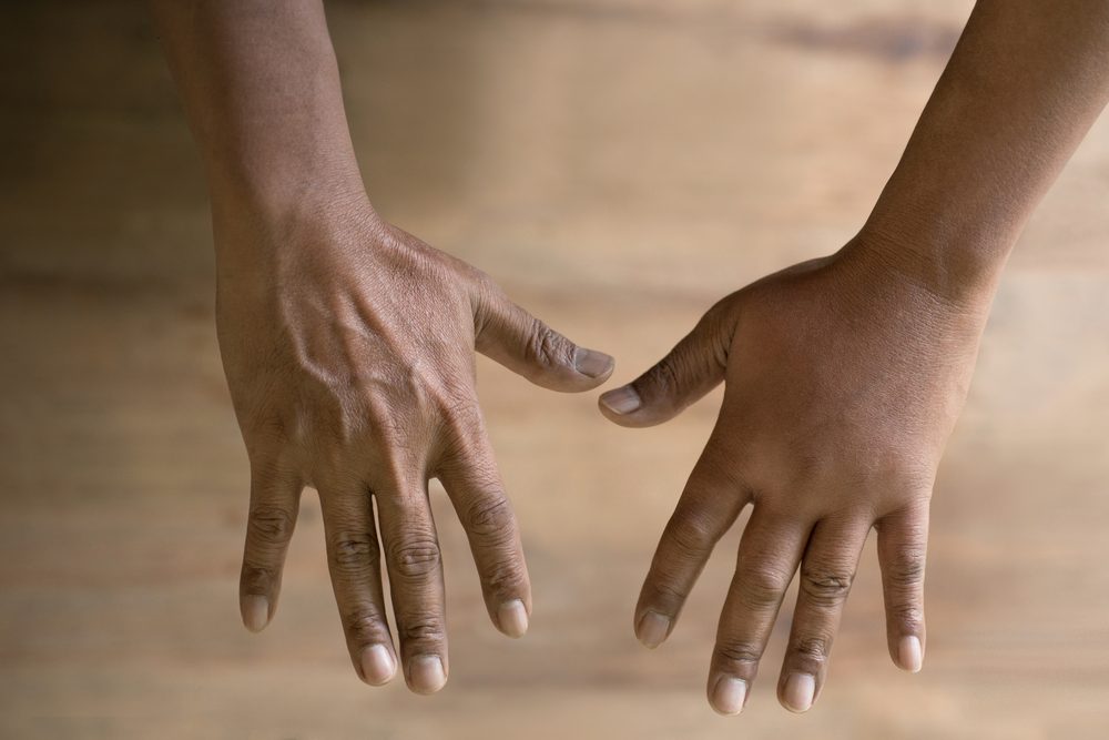 الفرق بين اليدين بسبب التورم| shutterstock