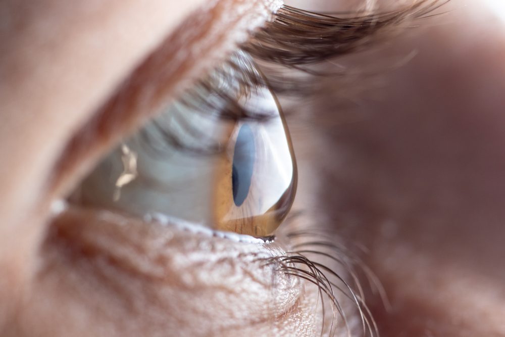 شكل قرنية عين شخص مصاب بالاستجماتيزم| shutterstock