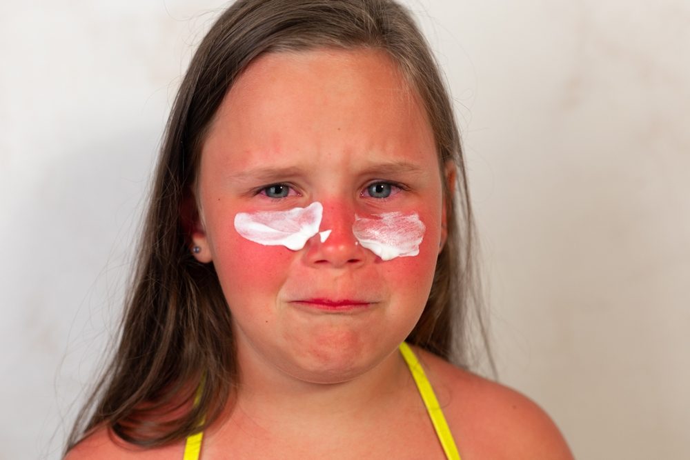 طريقة لإزالة حروق الشمس في المنزل