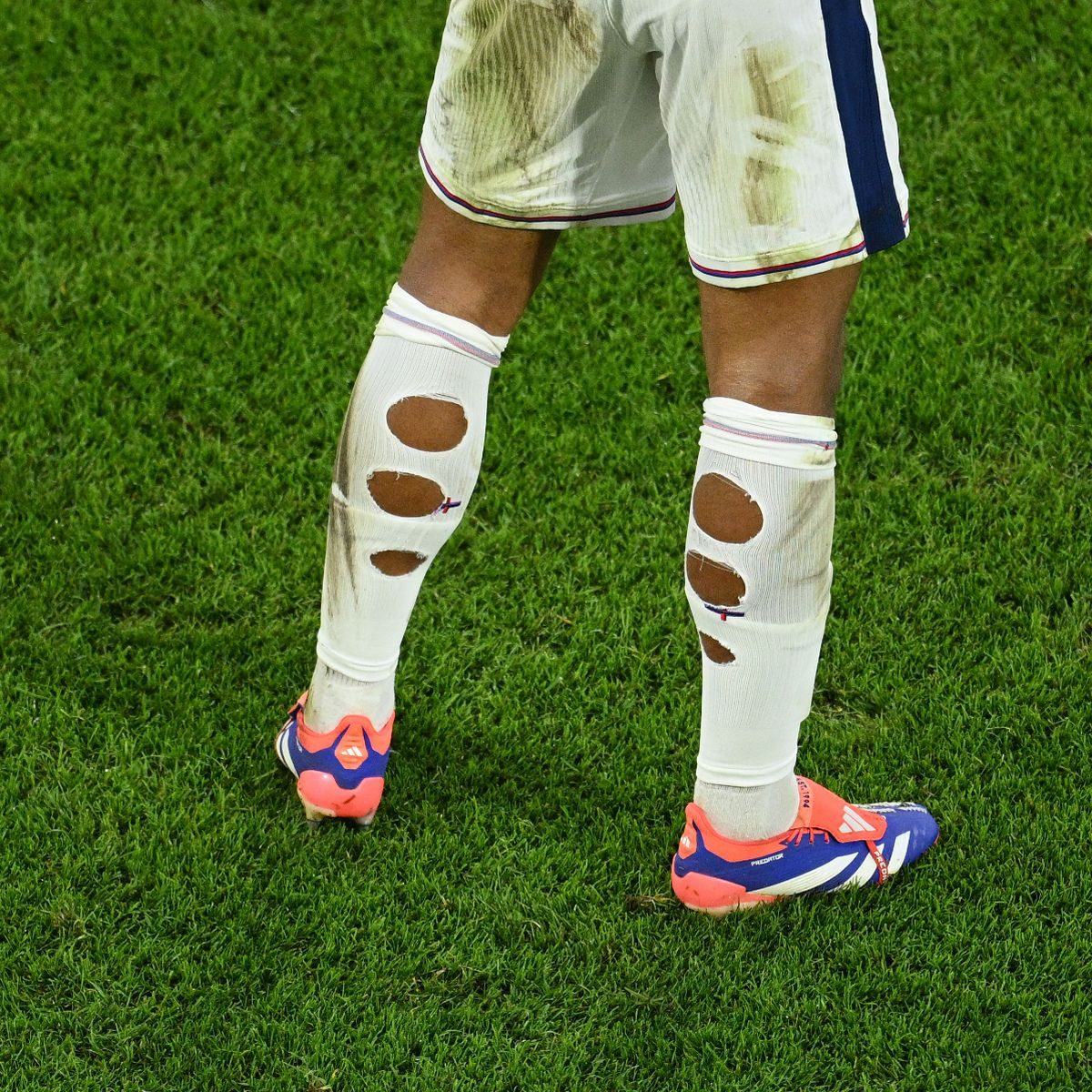 أسباب تمزيق جوارب اللاعبين