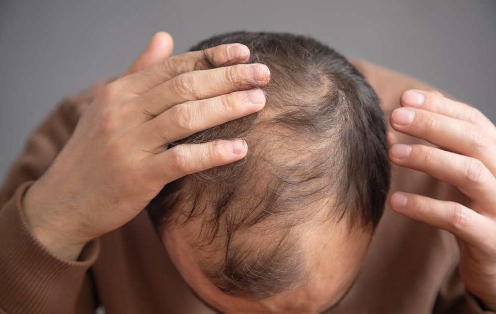 شخص يعاني من الصلع الوراثي| shutterstock